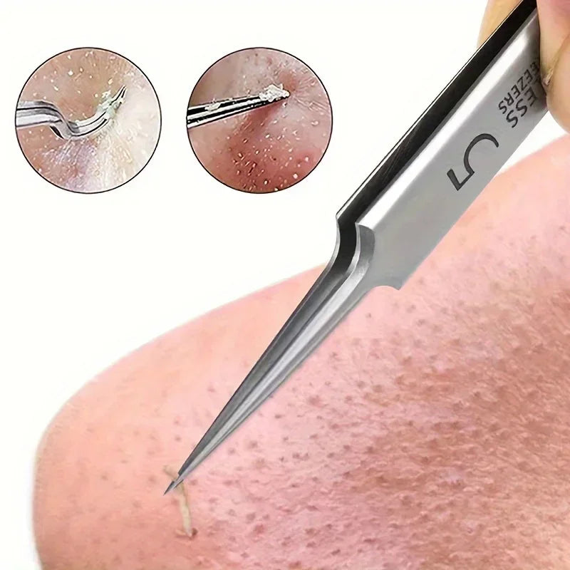 Acne Tweezers for Blackhead Removal