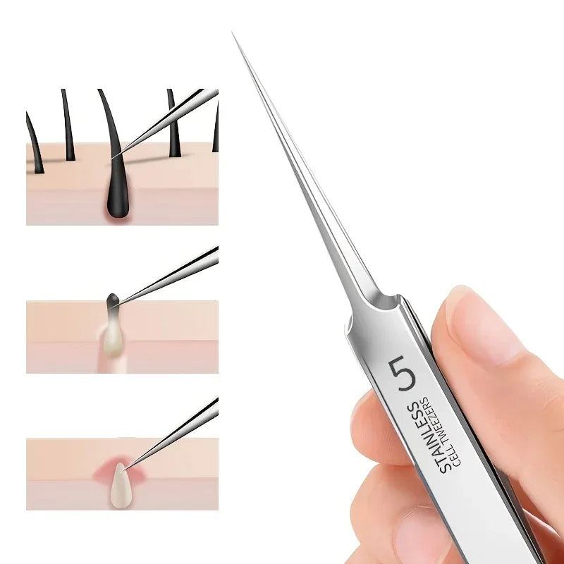 Acne Tweezers for Blackhead Removal