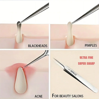 Acne Tweezers for Blackhead Removal